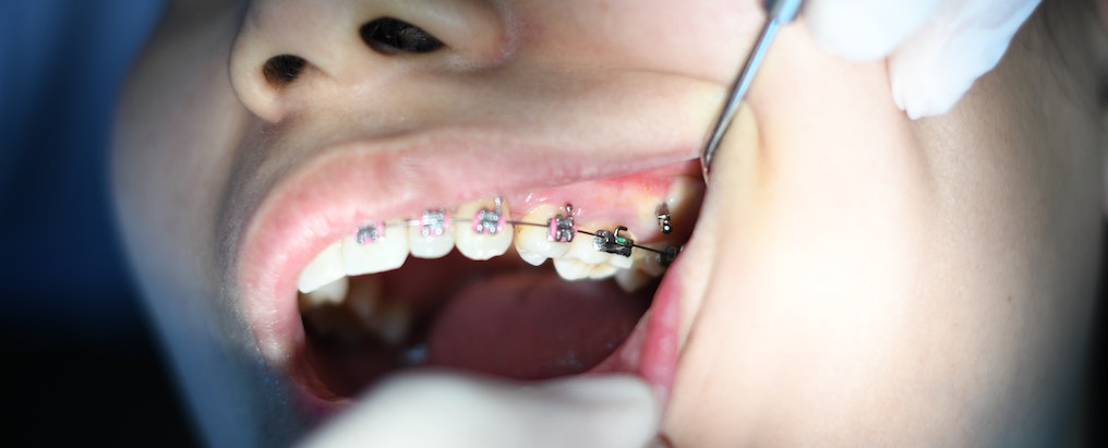 歯列矯正で正しい位置に八重歯を誘導しよう！