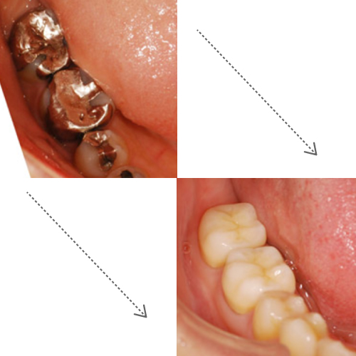 銀歯が気になる方