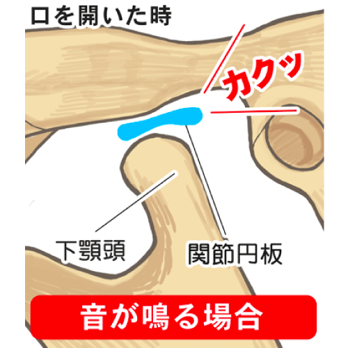 歯ぎしりの種類