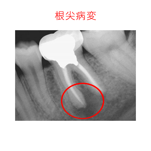 根尖病巣